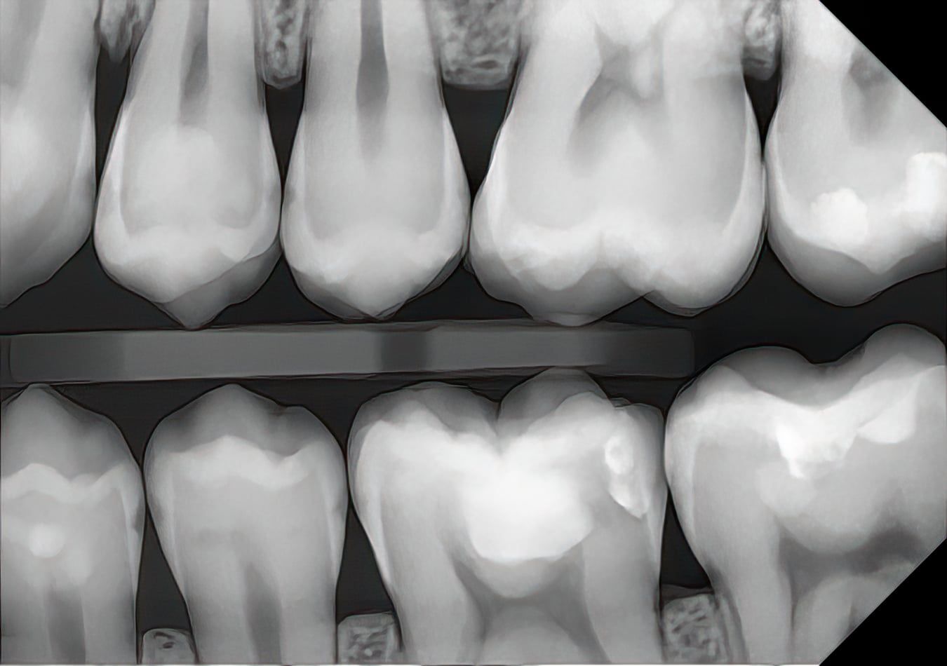 Unfiltered DC-Air™ posterior bitewing radiograph at high magnification, enamel and dentin detail