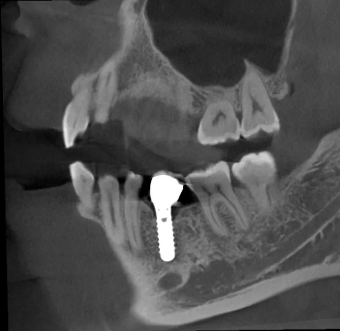 Sagittal CBCT slice showing a restored dental implant, captured on a J. Morita Veraview X800