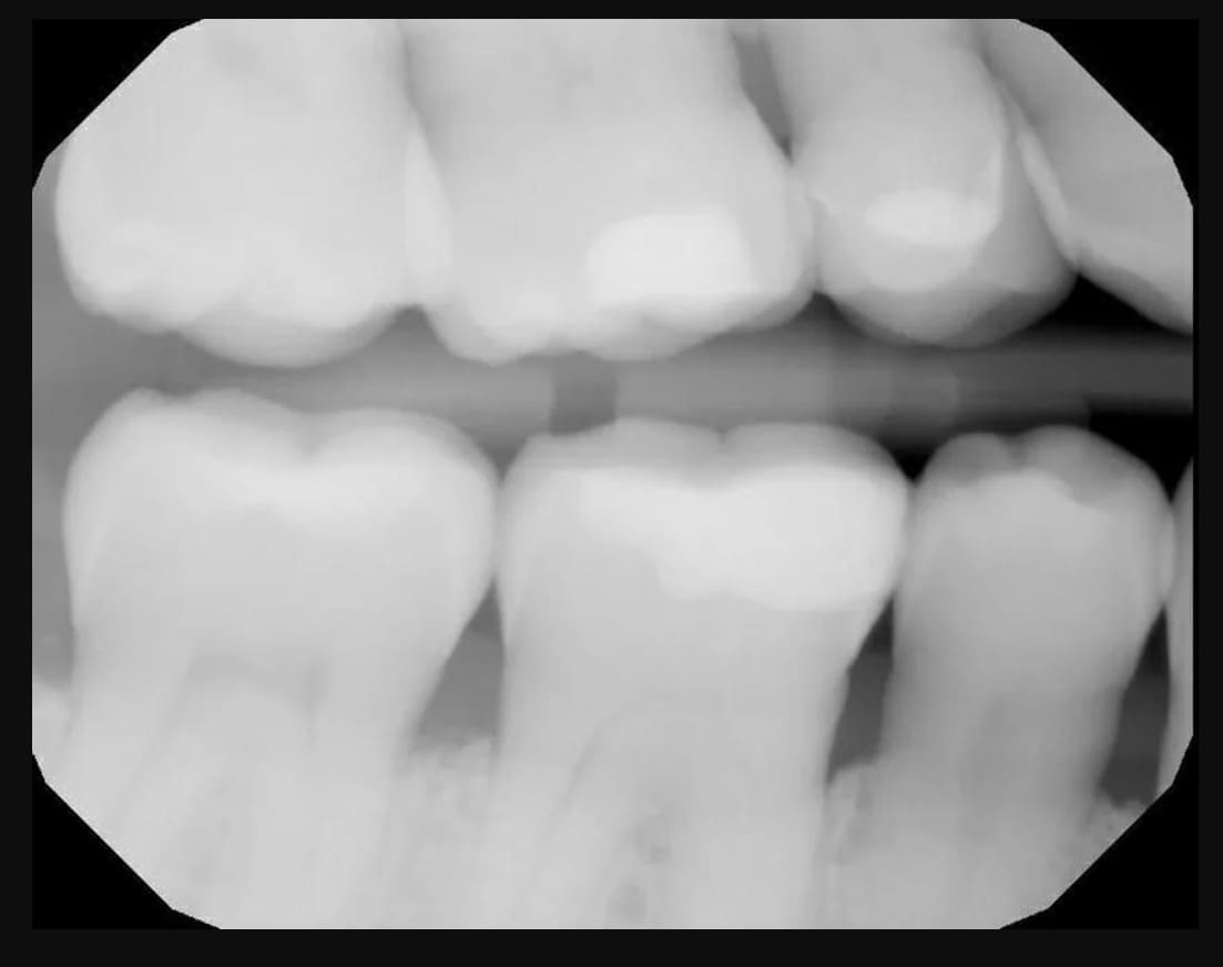 Blurred grayscale bitewing radiograph showing upper and lower premolars and molars with soft, indistinct edges, and a horizontal radiopaque bar crossing between the two arches.