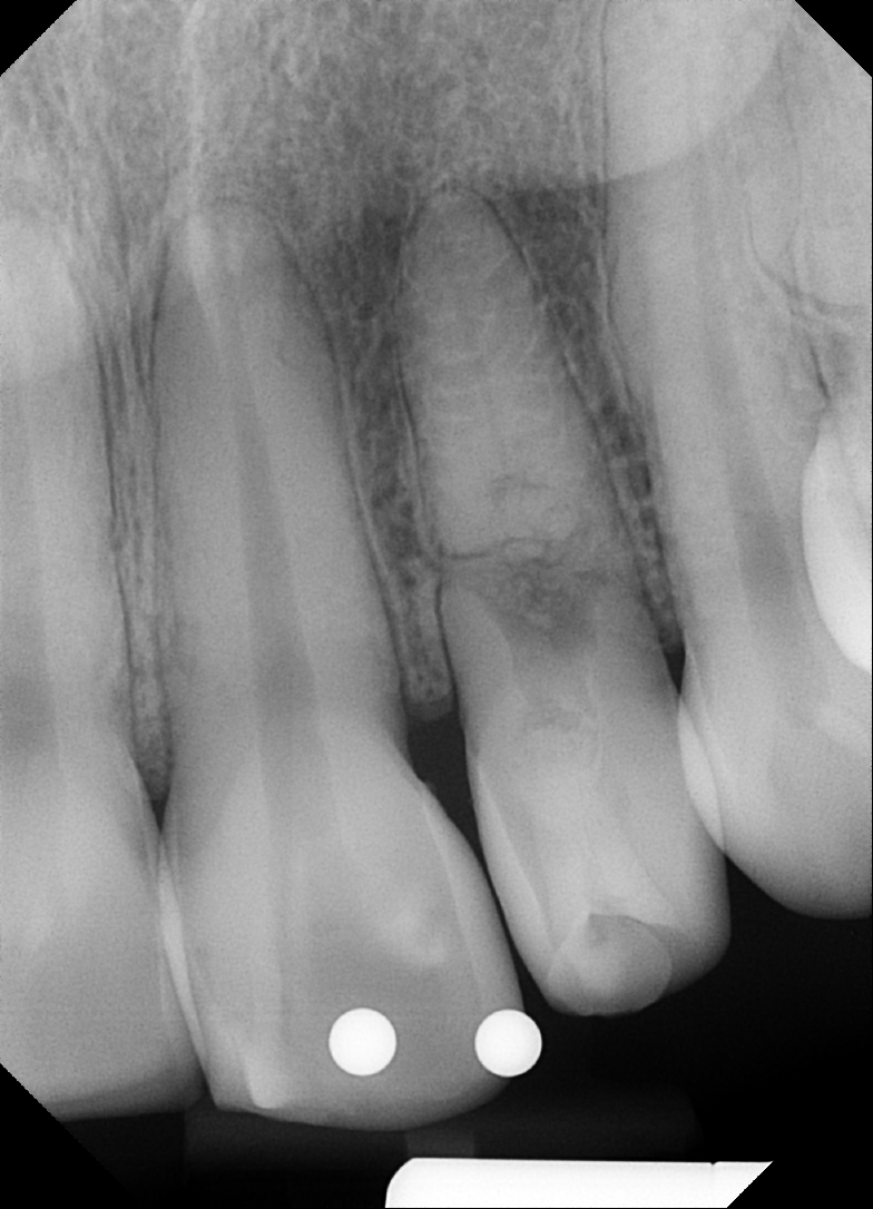 Periapical intraoral radiograph of the maxillary anterior teeth showing an irregular radiolucent widening within the root canal of the center tooth