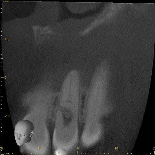 Sagittal CBCT slice through the maxillary anterior tooth showing an irregular radiolucent enlargement within the root canal near the sinus floor