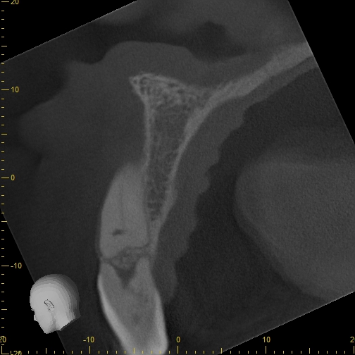 Coronal CBCT slice through the same tooth root showing the widened, irregular canal space adjacent to the maxillary sinus