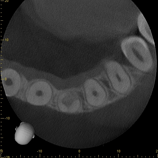 Axial CBCT slice through the maxillary arch showing cross-sectional views of several root canals along the arch