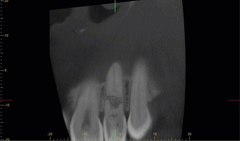 Animated sagittal CBCT scroll through the tooth root with a centered crosshair reticle marking the canal