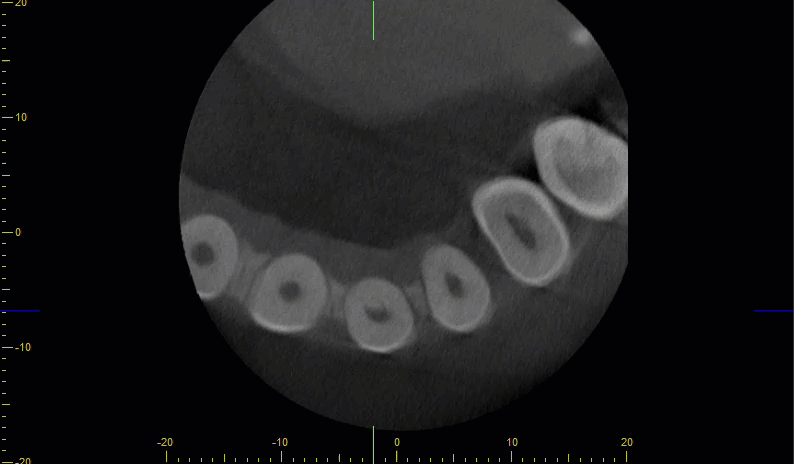 Animated axial CBCT scroll showing circular cross-sections of the roots along the dental arch