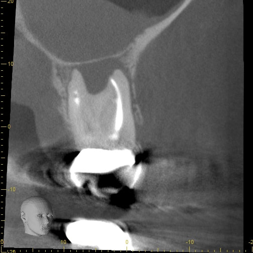 CBCT cross-sectional slice showing a tooth root with a dark radiolucent area beneath the apex