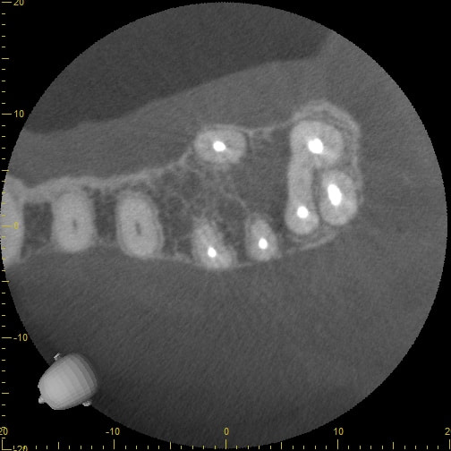 CBCT axial slice showing a cross-section of the dental arch with bright root canal fillings visible in several teeth