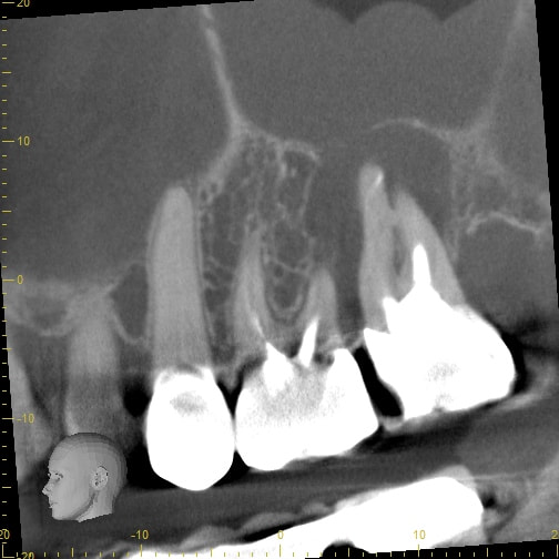 CBCT cross-sectional slice showing multiple molar roots, two of which have bright root canal fillings