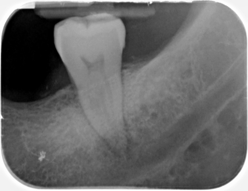 2D periapical radiograph of a molar tooth showing the crown, root outline, and surrounding bone in a single flat view