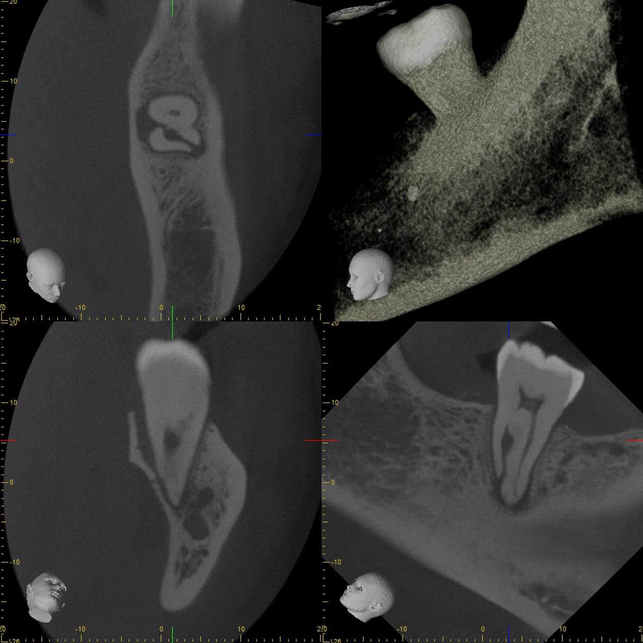 CBCT four-panel view of the same molar showing an axial cross-section of the canal system, a 3D surface rendering, and sagittal and coronal slices through the root