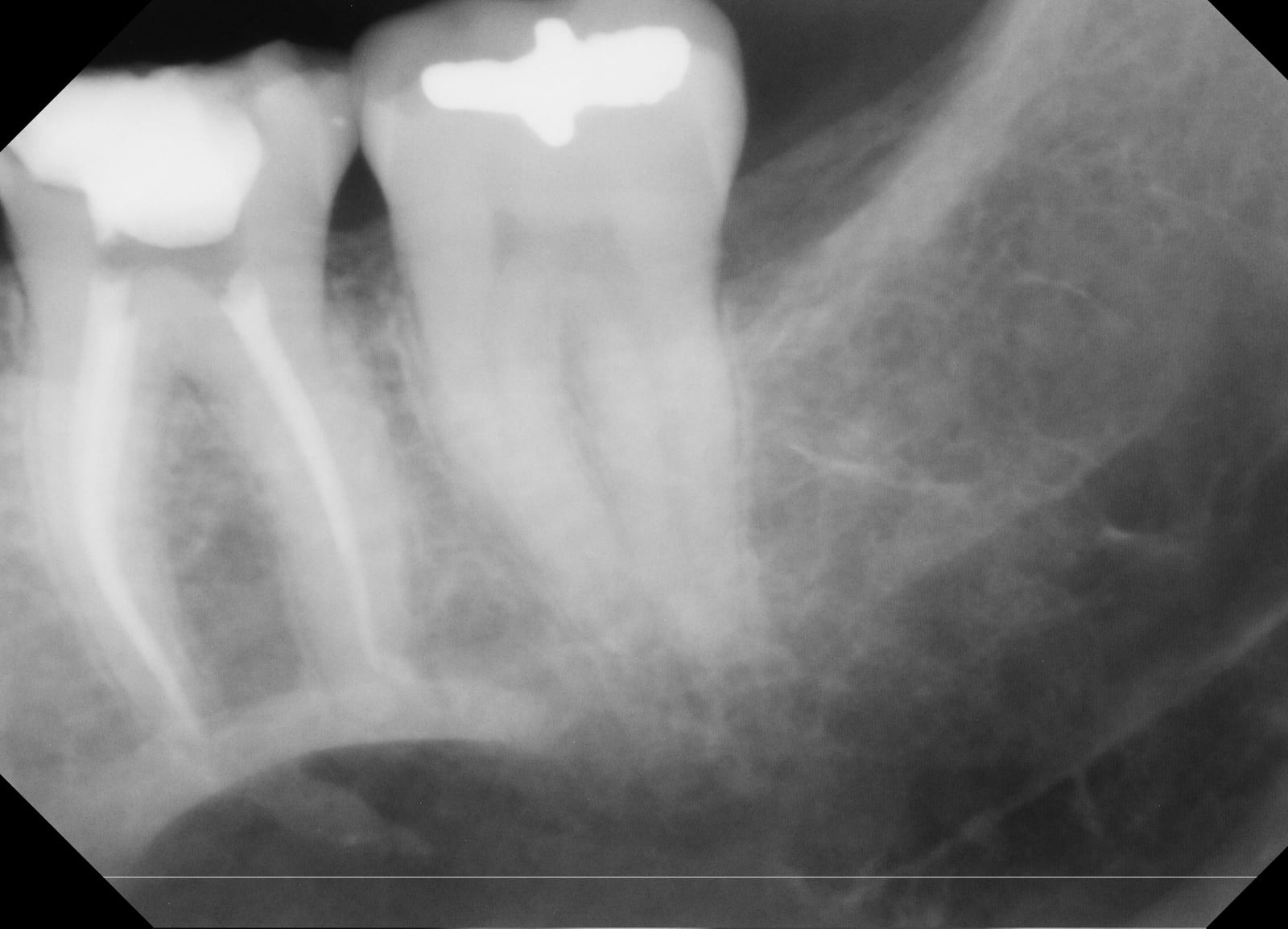 2D periapical radiograph of two lower molars with root canal filling material visible, showing roots and surrounding bone in a single flat view