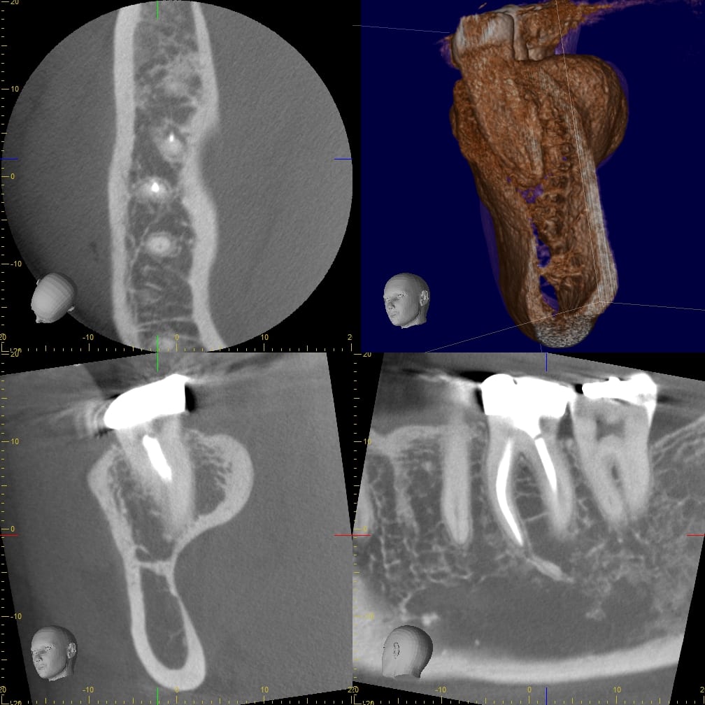 CBCT four-panel view of the same molar showing an axial slice, a 3D root rendering, and cross-sectional views revealing a bony ridge contour along the root surface not visible on the 2D image