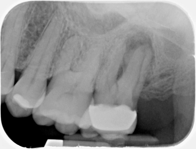 2D periapical radiograph of the upper premolar and molar region, including tooth #15, showing crowns and roots in a single flat view
