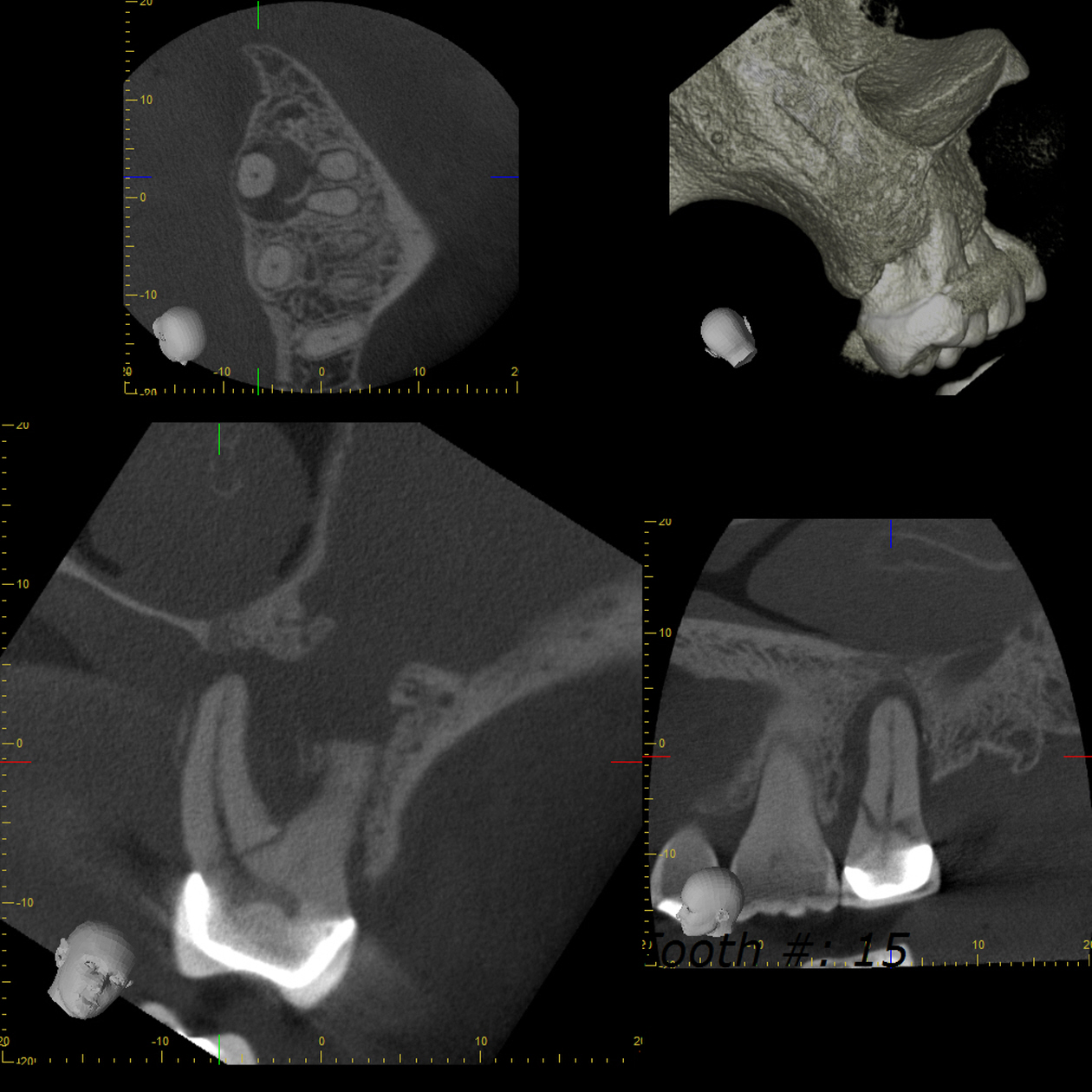 CBCT four-panel view labeled Tooth #15, showing an axial cross-section, a 3D bone rendering, and sagittal and coronal slices through the root and canal filling