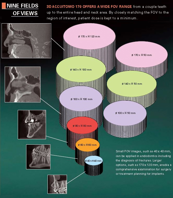 Infographic of the J. Morita 3D Accuitomo 170's nine field-of-view sizes, shown as nested cylinders from 40x40mm to 170x120mm each paired with a sample scan image