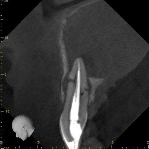 High-resolution .08mm voxel CBCT sagittal slice of a single tooth showing a bright root canal filling and root anatomy in fine detail