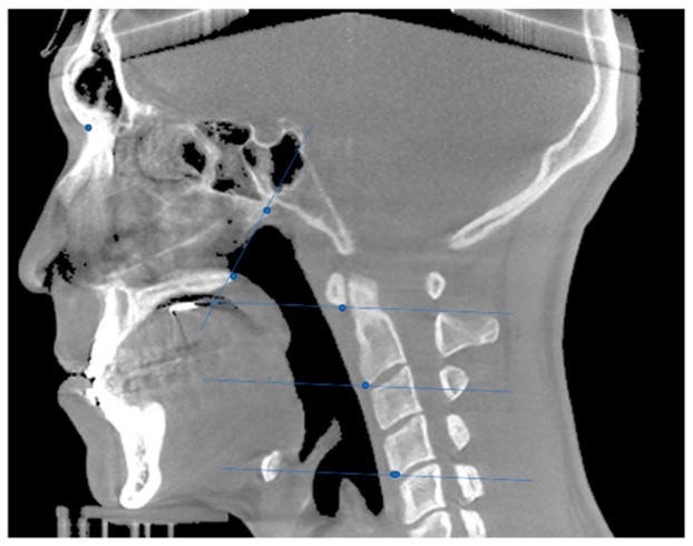 Lower-resolution .40mm voxel sagittal CBCT scan of the head and neck with blue measurement lines marking airway landmarks and the cervical spine
