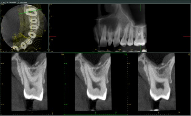 CBCT software screen showing a curved MPR panel and panoramic reconstruction of a molar above three cross-sectional axial slices