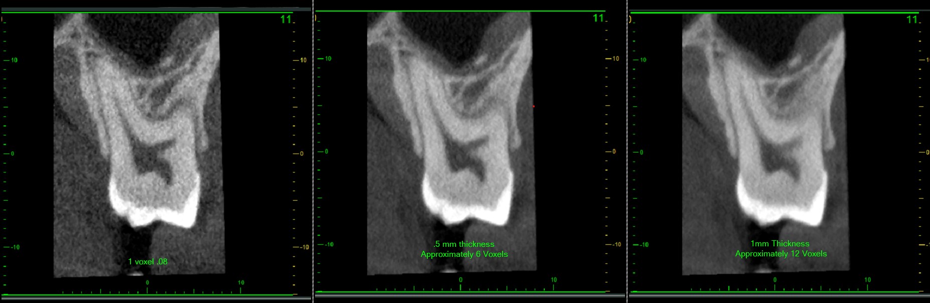 Three side-by-side CBCT slices of the same molar root comparing image detail at 0.08mm, 0.5mm, and 1mm slice thickness