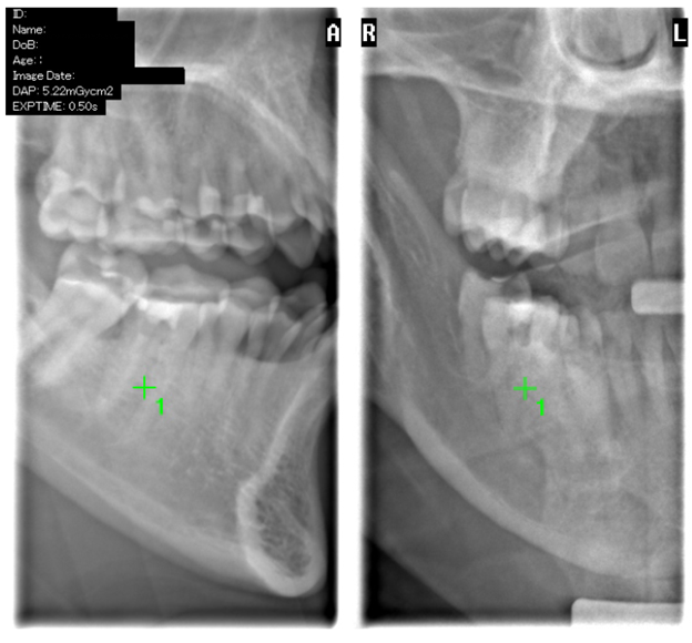 Two lateral 2D scout radiographs of the jaw with a green crosshair marking the selected center point for a small-FOV CBCT scan