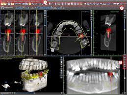 BlueSky Plan software interface showing 3D dental arch views, a panoramic curve, and a 3D jaw model used to design a surgical guide