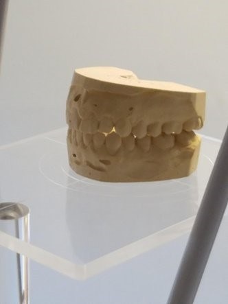 Stone dental model of the upper and lower arches displayed on a stand