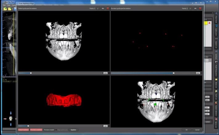 BlueSky Bio scan appliance alignment window showing CBCT cross-sections, a point cloud of radiopaque markers, and a merged 3D alignment view