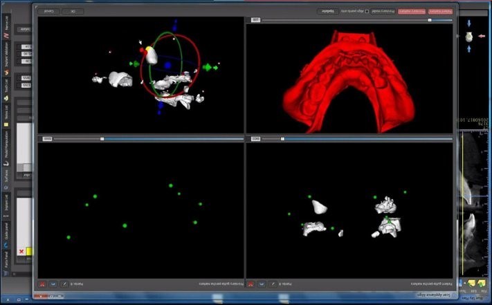 BlueSky Bio alignment screen matching green radiopaque marker points between the scanned model and the red-rendered appliance data