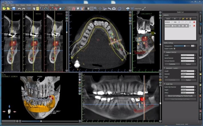 BlueSky Plan implant-planning screen with cross-sectional slices, a panoramic view, and a 3D mandible render showing a virtually placed implant