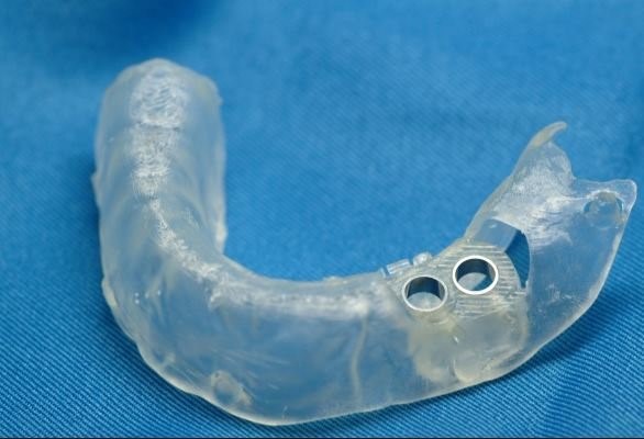 Dental Surgical Guide
