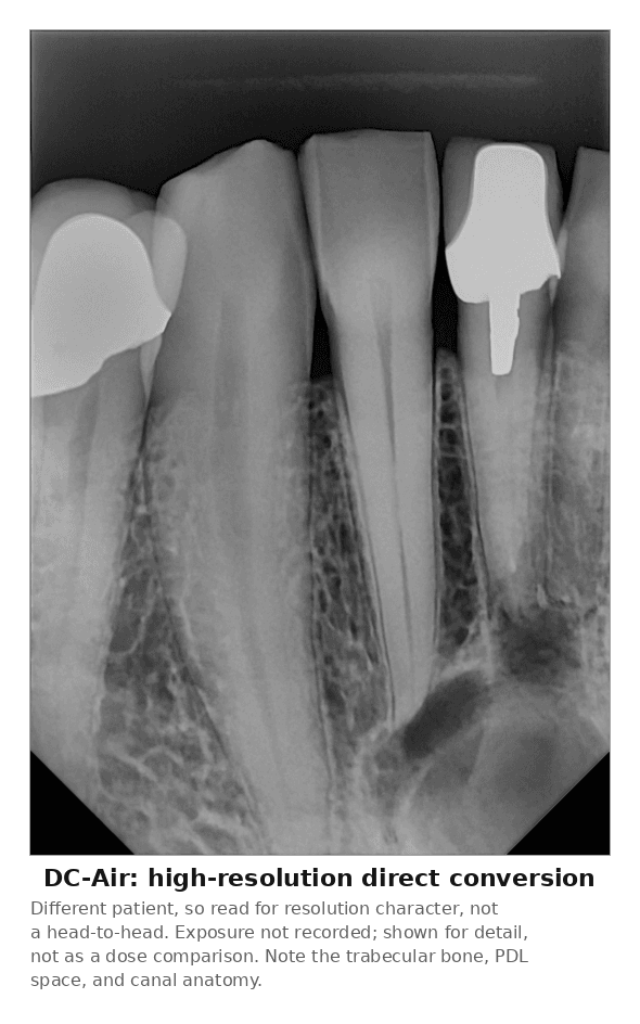 DC-Air™ direct-conversion periapical capture of upper anterior teeth, one with a full crown and one with a post-and-core restoration, resolving trabecular bone, the PDL space, and canal anatomy in fine detail.