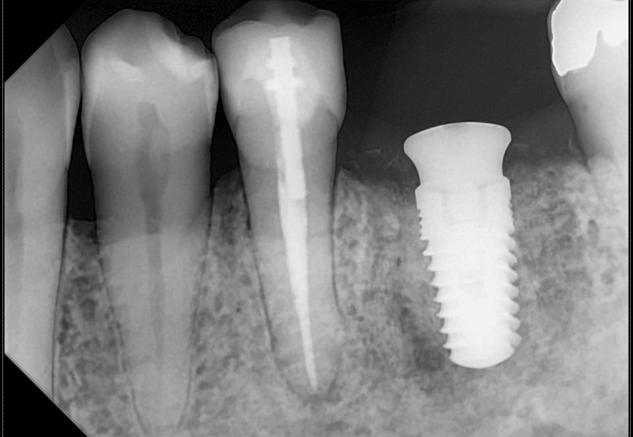A DC-Air™ direct-conversion periapical showing a root-canal-treated tooth next to a threaded dental implant, with bone trabeculation visible in close contact along the implant threads.