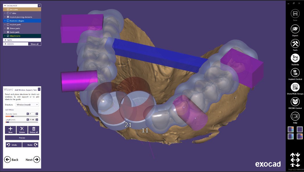 Screenshot of Exocad surgical guide design software showing a 3D dental arch model with colored implant and support components overlaid