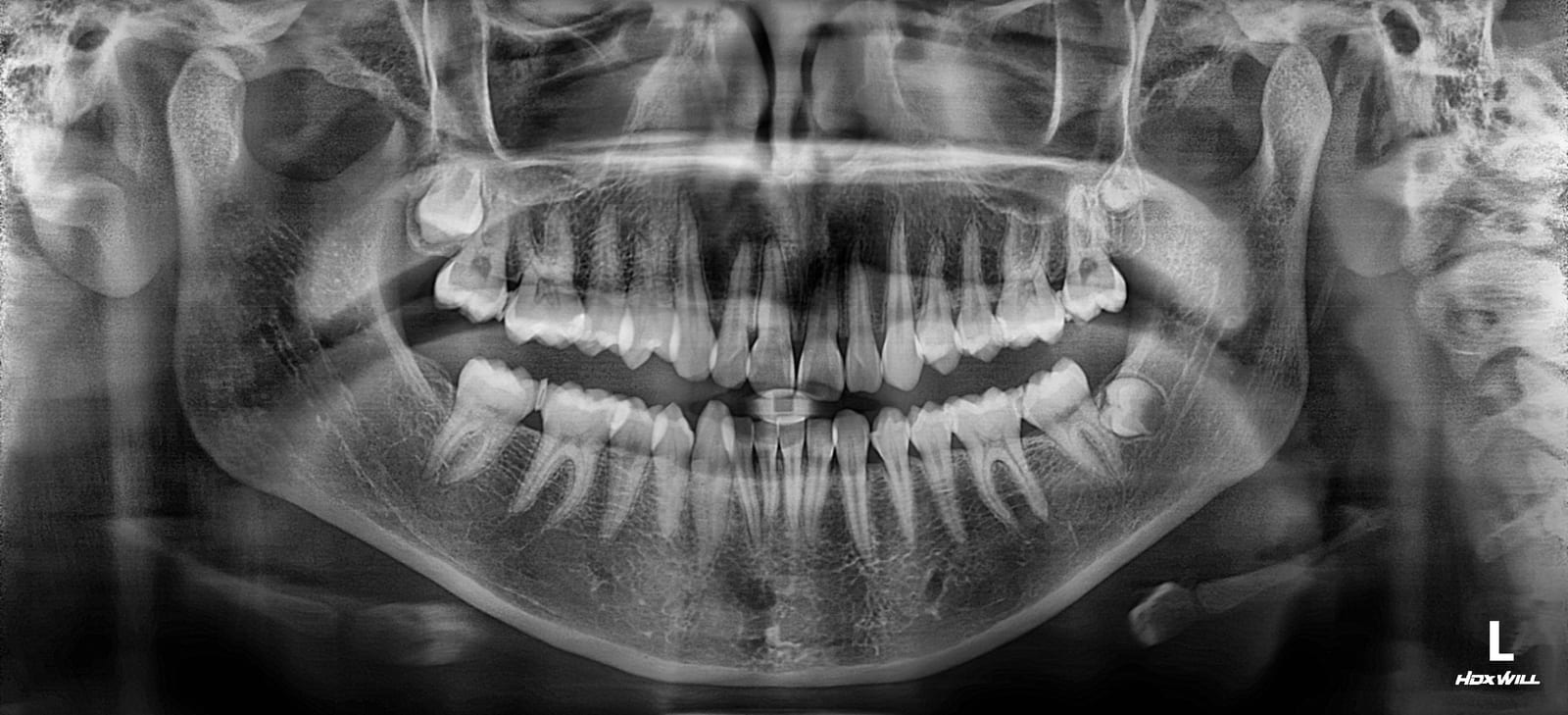 Full-mouth panoramic radiograph showing the complete upper and lower dental arches with the jaw joints and surrounding bone structure