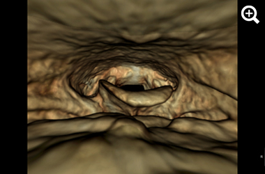 Endoscopic view of airway