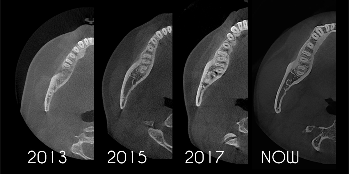 Example of HDX Will's Cyoptix algorithm improvements over time.