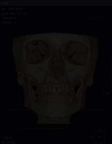Animated 3D CBCT volume rendering zooming from a full frontal skull view to a close-up of the anterior teeth, with a pink soft-tissue STL model merged onto the bone anatomy