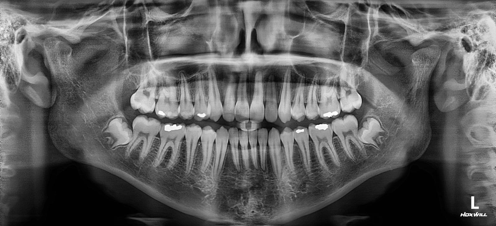 Full-mouth panoramic radiograph of both dental arches with several posterior teeth showing bright radiopaque fillings