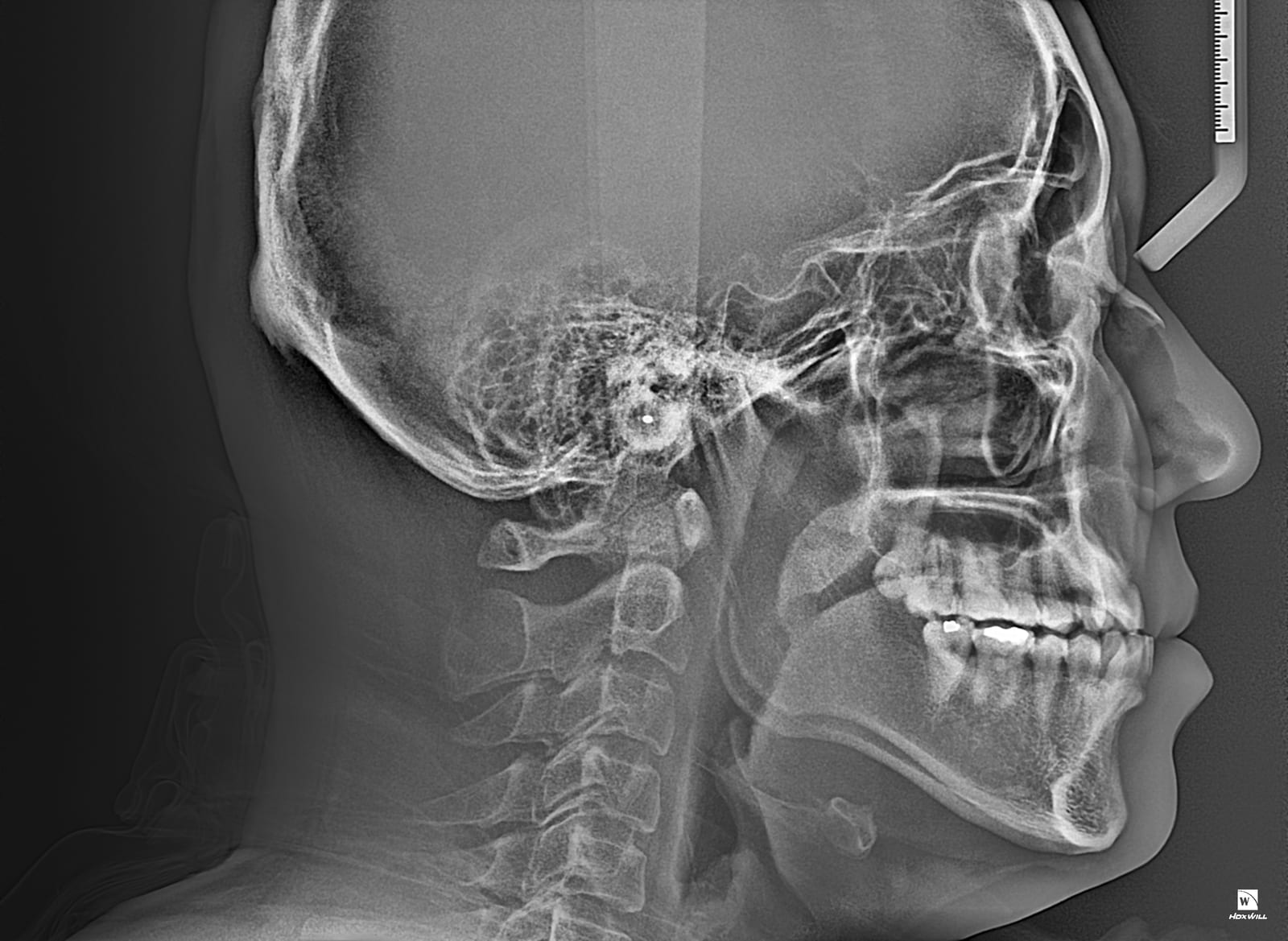 Lateral cephalometric radiograph showing a profile view of the skull, jaw, and cervical spine with a calibration ruler in the corner