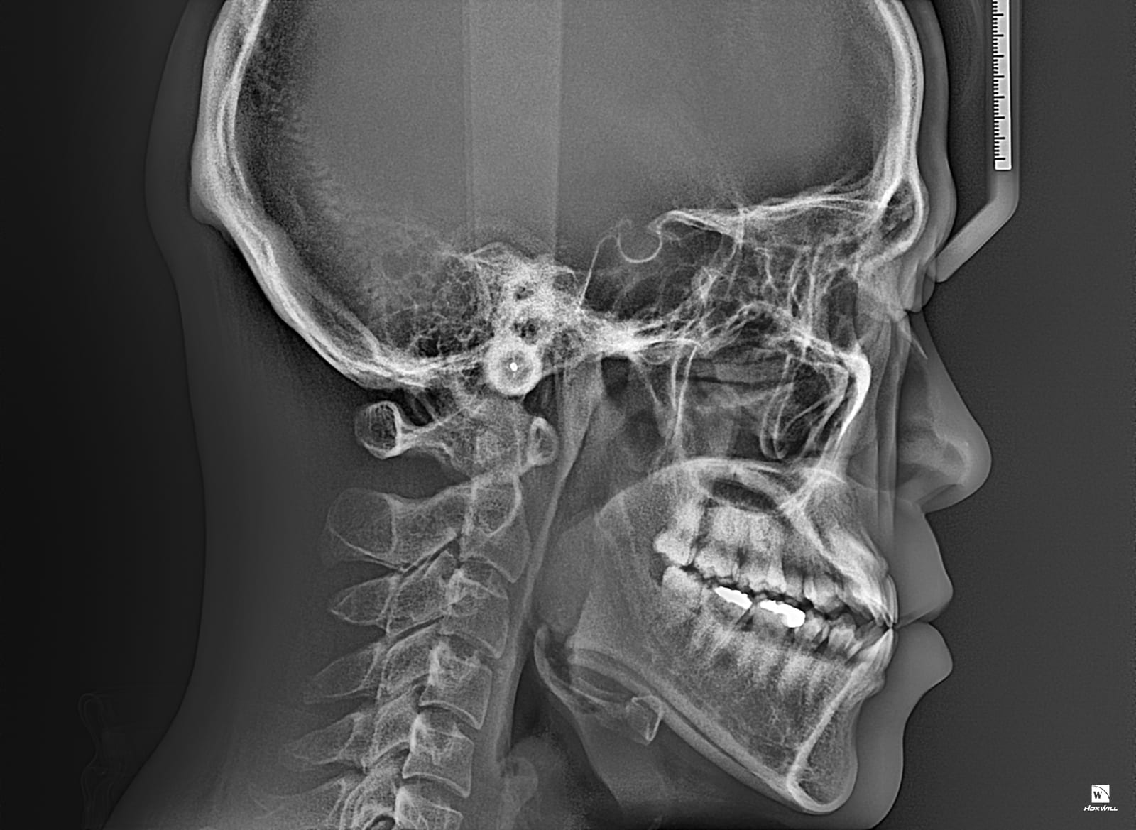Lateral cephalometric radiograph showing a profile view of the skull and jaw with fine anatomical detail through the sinuses and skull base
