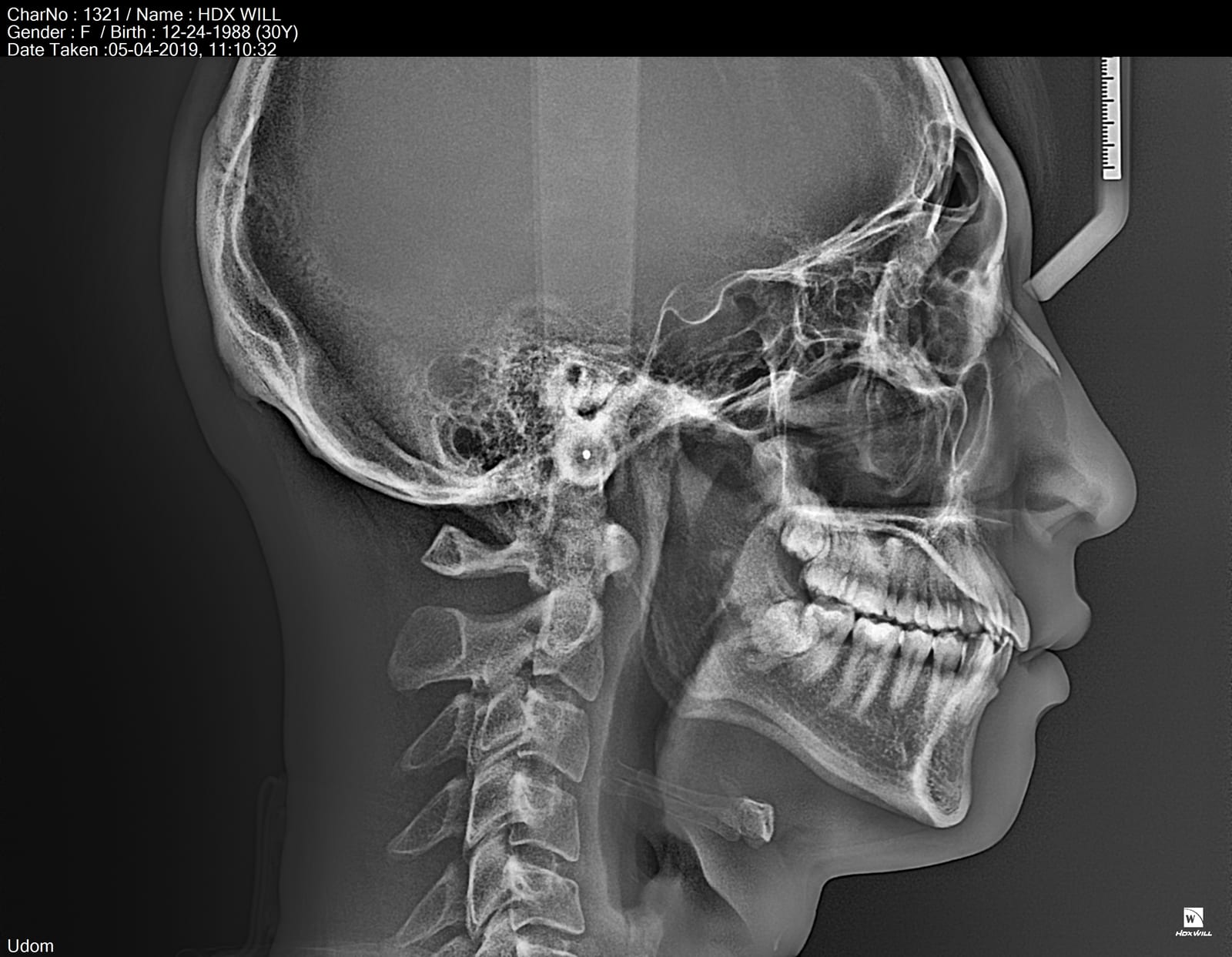 Lateral cephalometric radiograph in profile showing the skull, jaw, and cervical spine alongside a calibration ruler