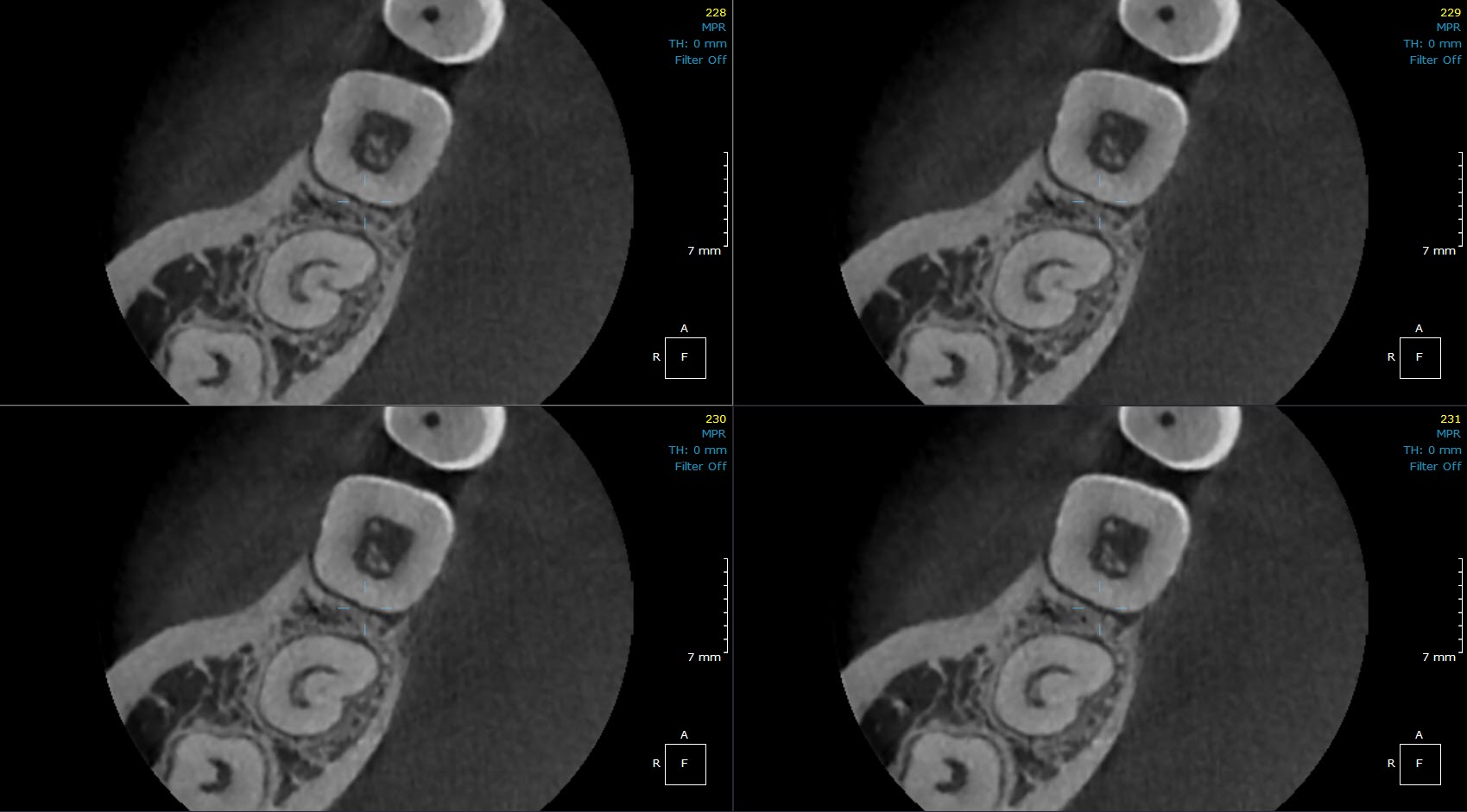 Four-panel grid of axial CBCT cross-sections through a molar and surrounding bone, each with a 7 mm measurement scale