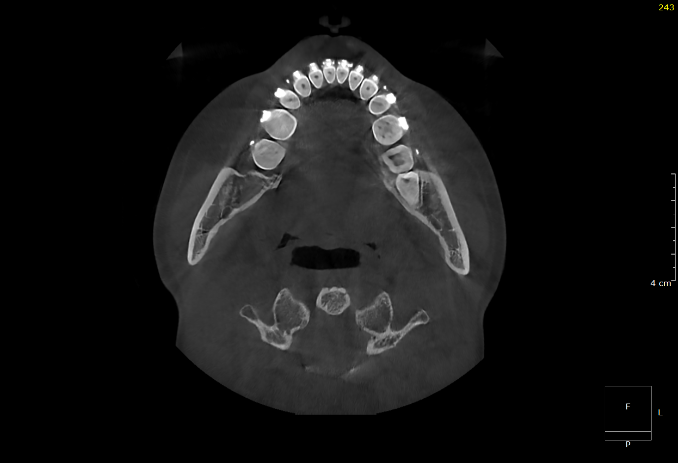 Axial CBCT slice through the mandible showing the full arch of teeth from above with the jaw condyles and cervical spine visible below