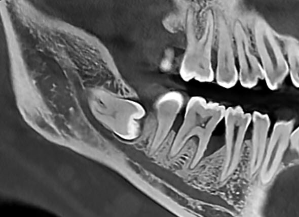 Close-up sagittal CBCT cross-section through the posterior mandible showing a molar's crown and root anatomy next to neighboring teeth