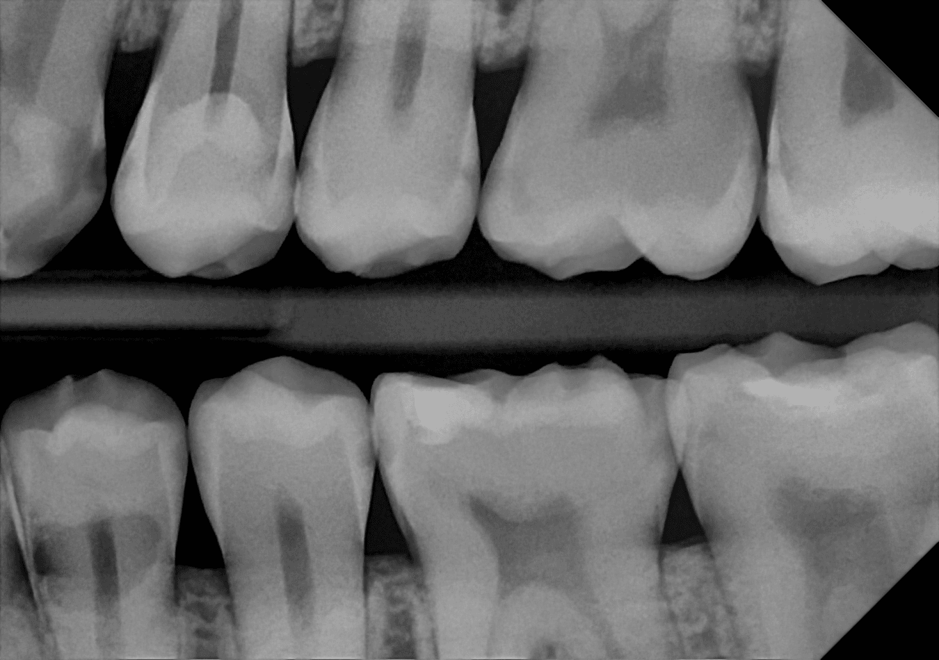 Full bitewing radiograph captured with the DC-Air™ sensor, showing sharp, native detail across the upper and lower posterior teeth