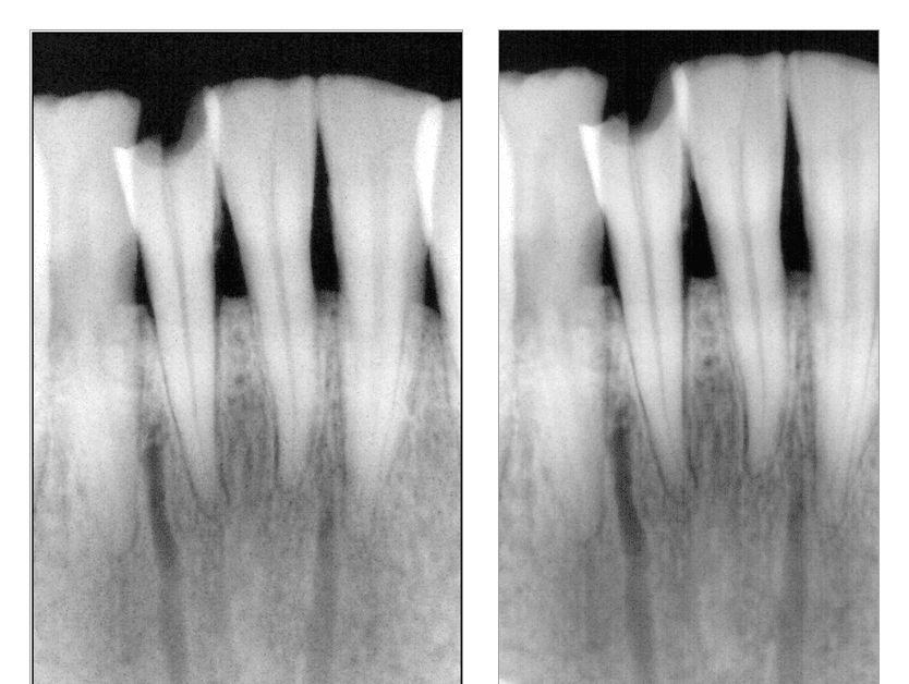 A low-dose intraoral sensor at 80 µGy versus 160 µGy — twice the detector dose with almost no additional detail, showing the sensor at its resolution ceiling.