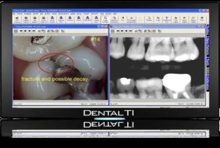 Screenshot of dental imaging software displaying an intraoral camera photo with a circled area and note beside a row of bitewing x-rays, framed by a monitor bearing the Dental TI logo