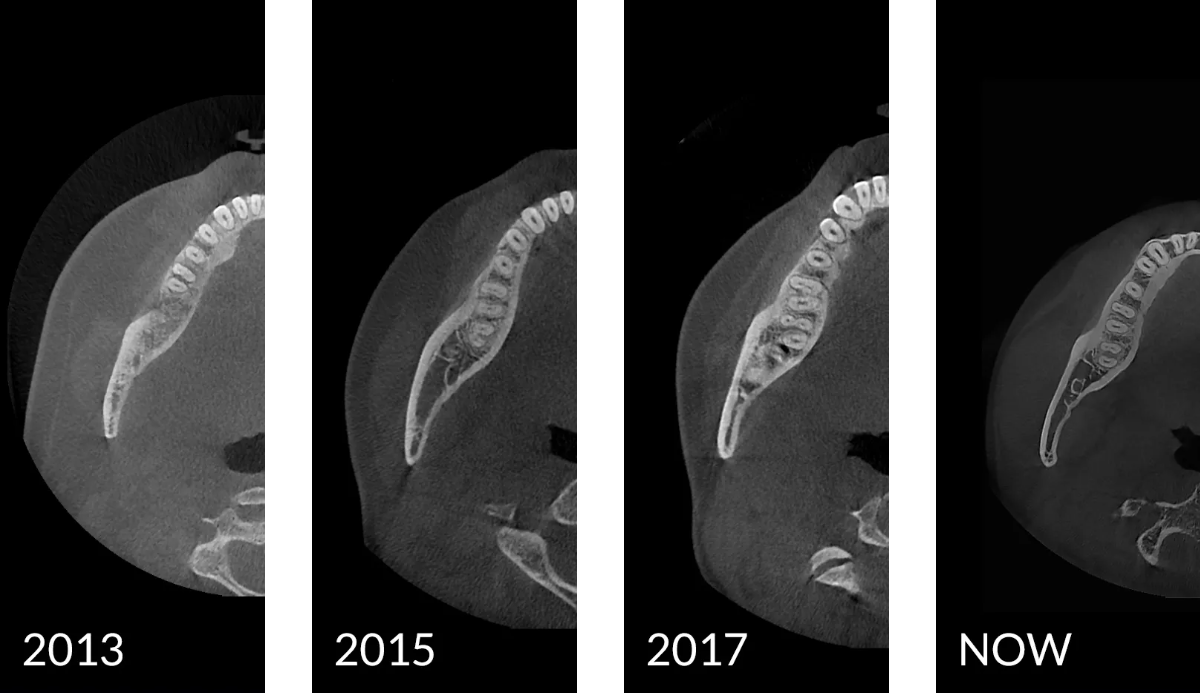 Axial slices showing the evolution of HDX Will's Cyoptix Processing Algorithm Over the Years