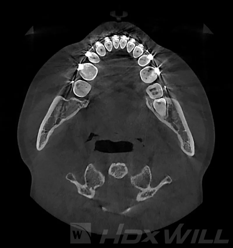 CBCT axial slice of a full dental arch showing tooth crowns in cross-section with the HDX Will logo watermark