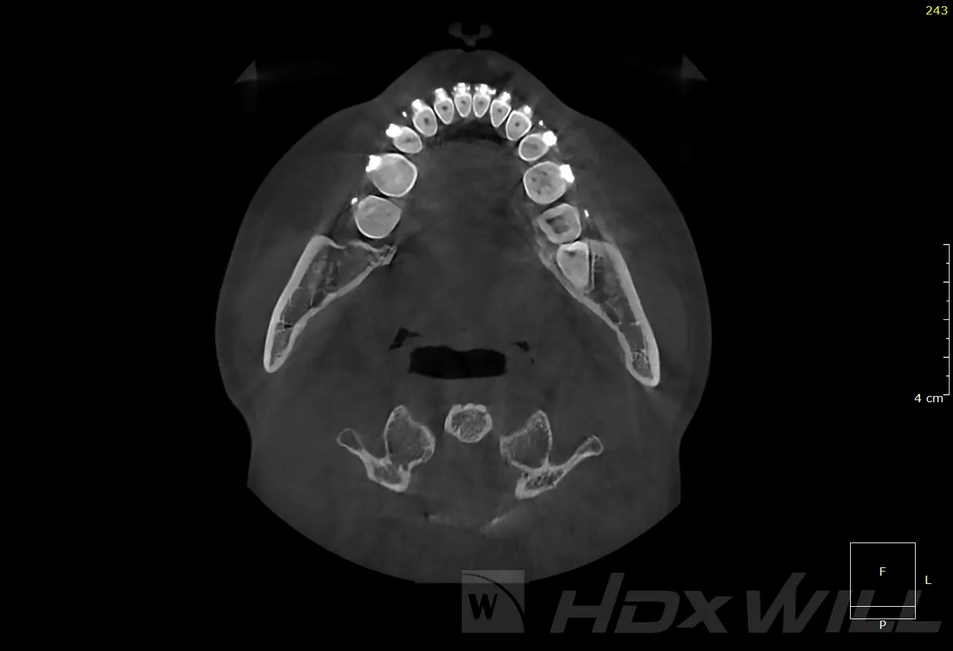 CBCT axial slice of a dental arch with a slice number and 4 cm scale bar overlay, HDX Will watermark visible
